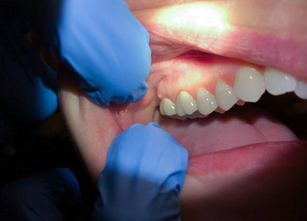 Teeth Whitening in ME